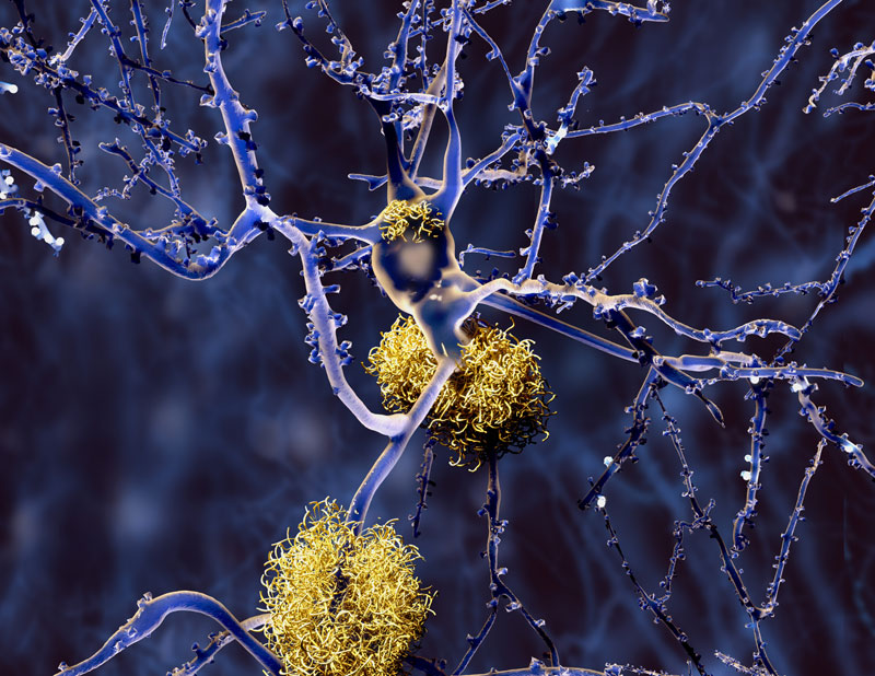 neurons in Alzheimer's disease